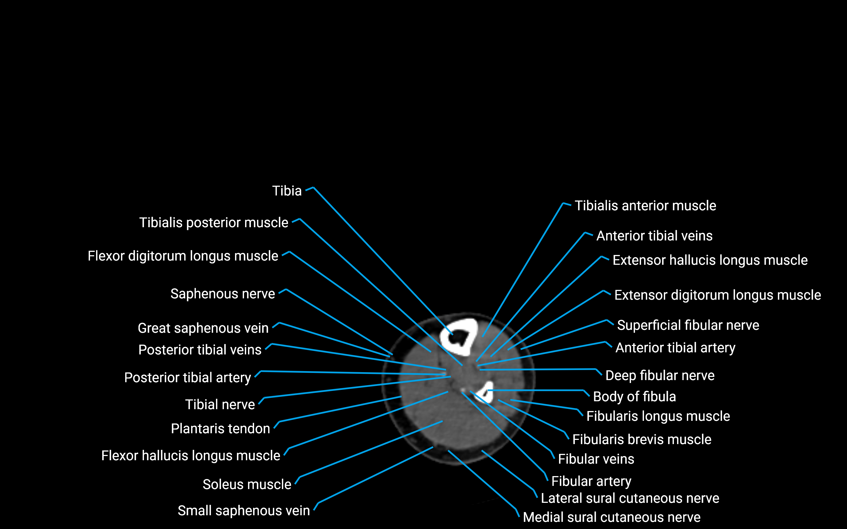 CT Lower leg axial cross sectional anatomy labelled image 126 (2).png
